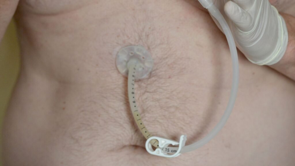 Sonda de gastrostomia com balão: indicações e benefícios da nutrição enteral